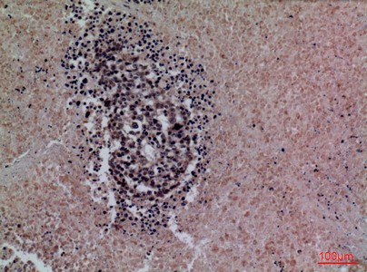 Fig2:; Immunohistochemical analysis of paraffin-embedded human-lung-cancer, antibody was diluted at 1:100