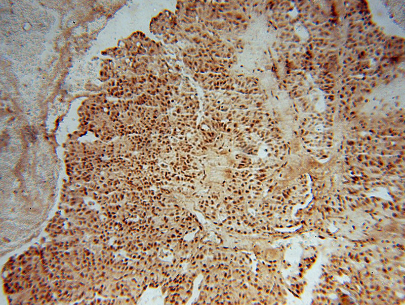 Immunohistochemical of paraffin-embedded human colon cancer using Catalog No:113429(OSBPL10 antibody) at dilution of 1:50 (under 10x lens)