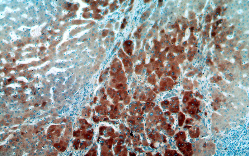 Immunohistochemical of paraffin-embedded human hepatocirrhosis using Catalog No:117341(TF antibody) at dilution of 1:50 (under 10x lens)