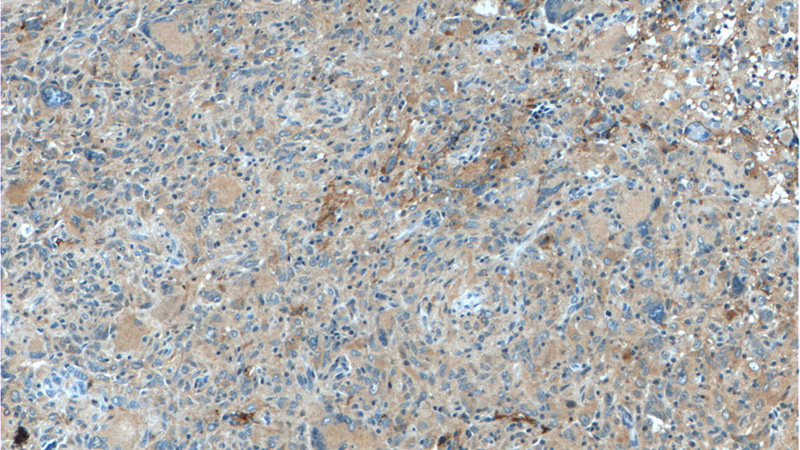 Immunohistochemistry of paraffin-embedded human gliomas tissue slide using Catalog No:109982(DKK1 Antibody) at dilution of 1:50 (under 10x lens)