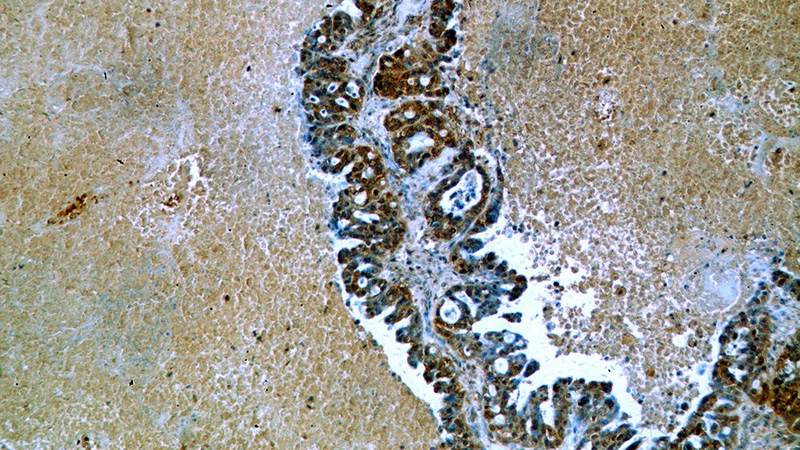 Immunohistochemical of paraffin-embedded human ovary tumor using Catalog No:107454(PAX8 antibody) at dilution of 1:50 (under 10x lens)