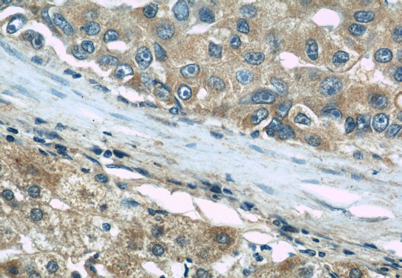 Immunohistochemical of paraffin-embedded human liver cancer using Catalog No:116022(BIGH3 antibody) at dilution of 1:50 (under 40x lens)