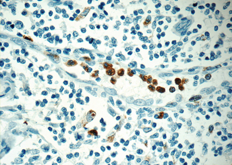 Immunohistochemistry of paraffin-embedded human tonsillitis tissue slide using (MPO Antibody) at dilution of 1:200