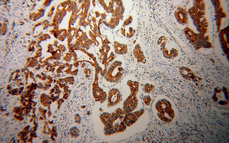 Immunohistochemical of paraffin-embedded human colon cancer using Catalog No:113582(PARD3 antibody) at dilution of 1:50 (under 10x lens)