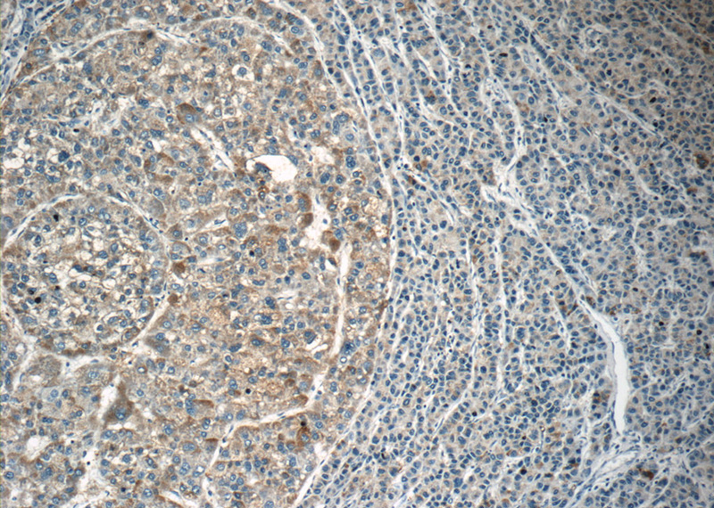 Immunohistochemistry of paraffin-embedded human liver cancer tissue slide using Catalog No:112143(LAPTM4B Antibody) at dilution of 1:50 (under 10x lens)