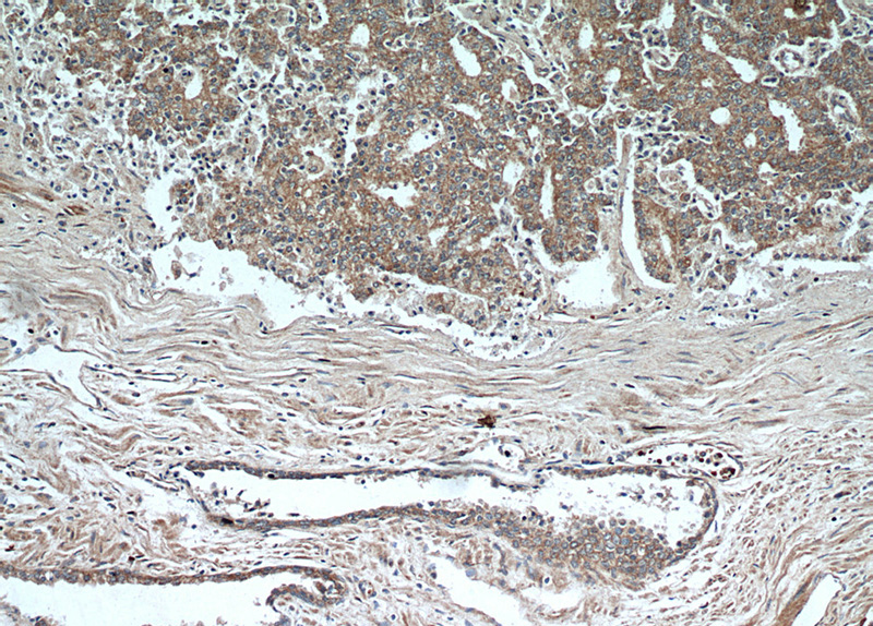 Immunohistochemical of paraffin-embedded human prostate cancer using Catalog No:113352(OPLAH antibody) at dilution of 1:50 (under 10x lens)