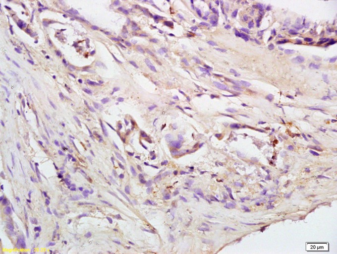 Fig1: Tissue/cell: human colon carcinoma; 4% Paraformaldehyde-fixed and paraffin-embedded;; Antigen retrieval: citrate buffer ( 0.01M, pH 6.0 ), Boiling bathing for 15min; Block endogenous peroxidase by 3% Hydrogen peroxide for 30min; Blocking buffer (normal goat serum,C-0005) at 37℃ for 20 min;; Incubation: Anti-Bak Polyclonal Antibody, Unconjugated 1:200, overnight at 4℃, followed by conjugation to the secondary antibody(SP-0023) and DAB(C-0010) staining