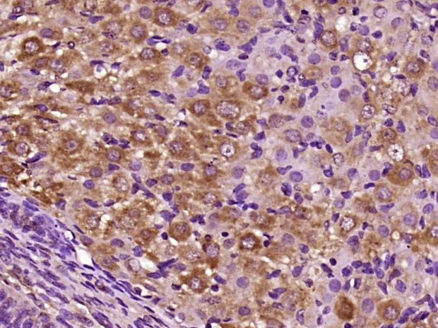 Fig2: Paraformaldehyde-fixed, paraffin embedded (Rat ovary); Antigen retrieval by boiling in sodium citrate buffer (pH6.0) for 15min; Block endogenous peroxidase by 3% hydrogen peroxide for 20 minutes; Blocking buffer (normal goat serum) at 37℃ for 30min; Antibody incubation with (CILP) Polyclonal Antibody, Unconjugated at 1:400 overnight at 4℃, followed by operating according to SP Kit(Rabbit) (sp-0023) instructionsand DAB staining.
