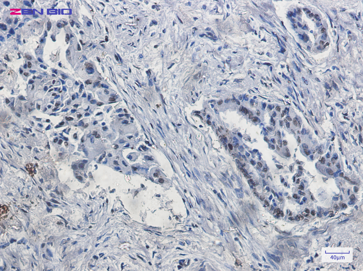 Immunohistochemistry of KDM4B/JMJD2B in paraffin-embedded Human lung cancer tissue using KDM4B/JMJD2B Rabbit pAb at dilution 1/20