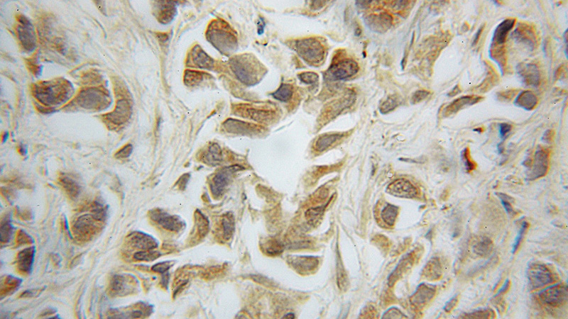 Immunohistochemical of paraffin-embedded human prostate cancer using Catalog No:112327(LRRC1 antibody) at dilution of 1:50 (under 10x lens)