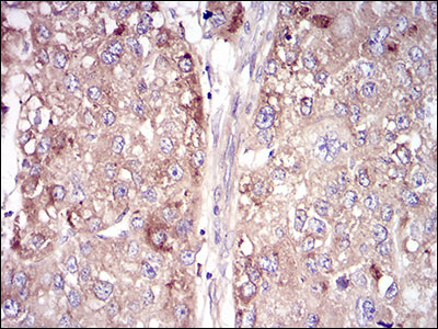Fig4: Immunohistochemical analysis of paraffin-embedded human liver cancer tissue using anti-VTN antibody. Counter stained with hematoxylin.