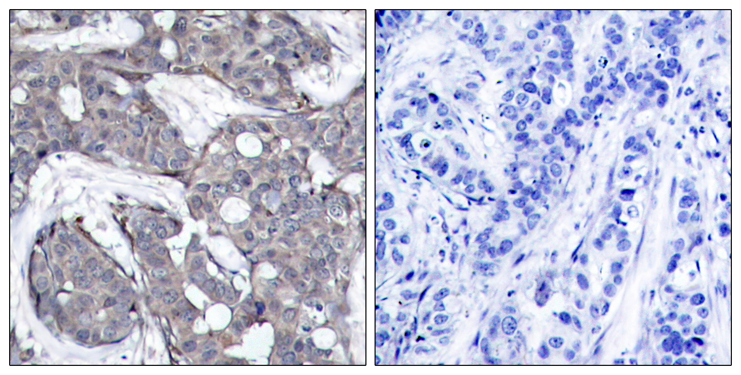 Immunohistochemical analysis of paraffin-embedded human breast carcinoma tissue using HSP27 (Phospho-Ser82) Antibody (left) or the same antibody preincubated with blocking peptide (right).