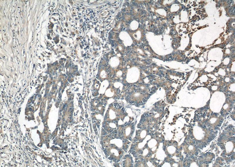 Immunohistochemical of paraffin-embedded human colon cancer using Catalog No:114657(RHOA antibody) at dilution of 1:50 (under 10x lens)