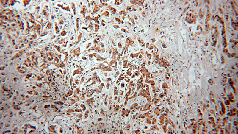 Immunohistochemical of paraffin-embedded human breast cancer using Catalog No:112959(NAT1 antibody) at dilution of 1:100 (under 10x lens)