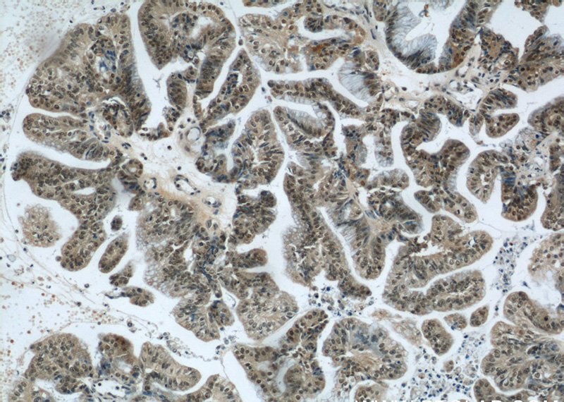 Immunohistochemical of paraffin-embedded human ovary tumor using Catalog No:116964(ZNF24 antibody) at dilution of 1:50 (under 10x lens)