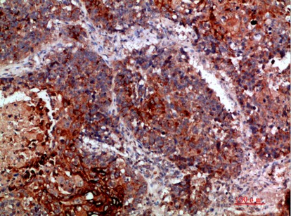 Fig1:; Immunohistochemical analysis of paraffin-embedded human-lung-cancer, antibody was diluted at 1:200