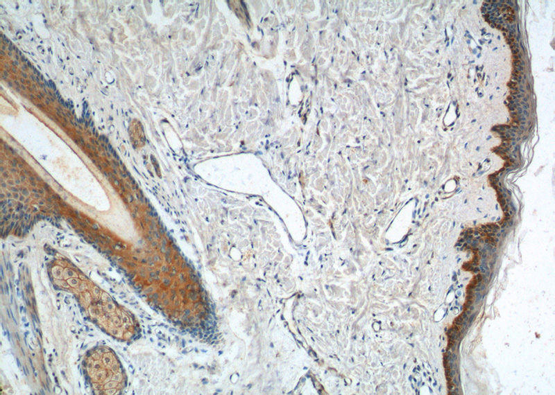 Immunohistochemistry of paraffin-embedded human skin tissue slide using Catalog No:109793(KRT14 Antibody) at dilution of 1:200 (under 10x lens).