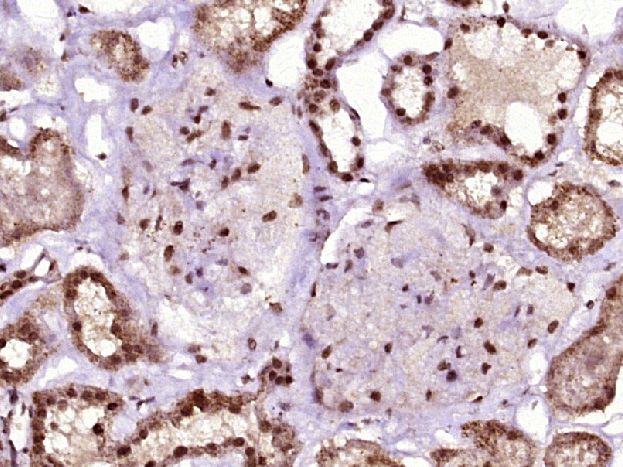 Fig1: Paraformaldehyde-fixed, paraffin embedded (Human kidney); Antigen retrieval by boiling in sodium citrate buffer (pH6.0) for 15min; Block endogenous peroxidase by 3% hydrogen peroxide for 20 minutes; Blocking buffer (normal goat serum) at 37℃ for 30min; Antibody incubation with (C10orf4) Polyclonal Antibody, Unconjugated at 1:400 overnight at 4℃, followed by operating according to SP Kit(Rabbit) (sp-0023) instructionsand DAB staining.