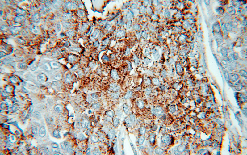 Immunohistochemical of paraffin-embedded human liver cancer using Catalog No:111457(HPSE antibody) at dilution of 1:50 (under 40x lens)