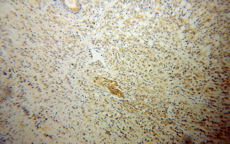 Immunohistochemical of paraffin-embedded human prostate cancer using Catalog No:112245(PPFIA1 antibody) at dilution of 1:100 (under 10x lens)