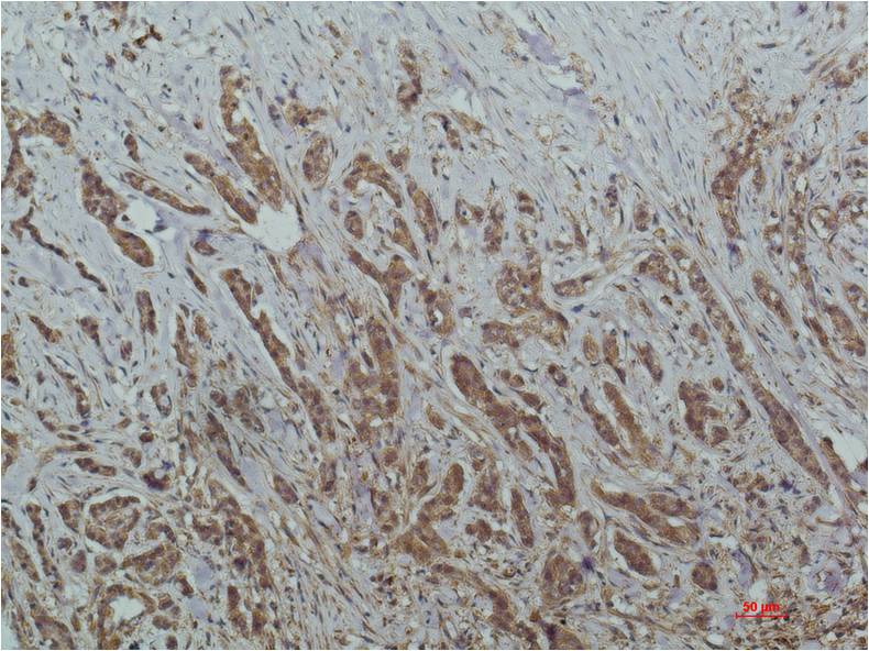 Immunohistochemical analysis of paraffin-embedded Human Breast Carcinoma Tissue usingHADC1 Mouse mAb diluted at 1:200.
