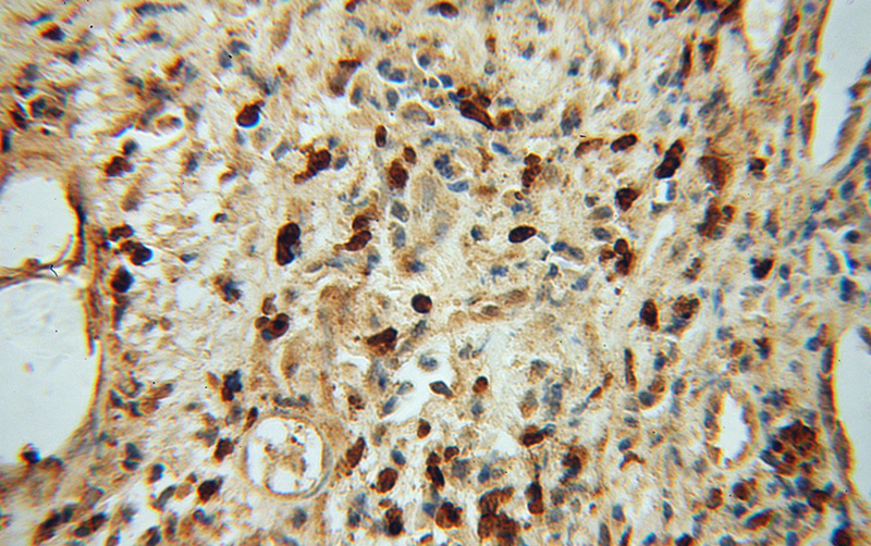 Immunohistochemical of paraffin-embedded human prostate cancer using Catalog No:113236(NR2C1 antibody) at dilution of 1:50 (under 40x lens). Heat mediated antigen retrieved with Citric acid buffer, pH6.0