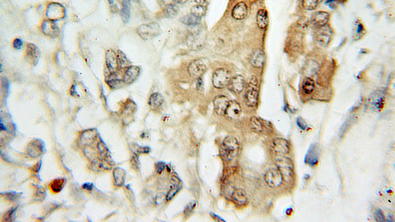 Immunohistochemical of paraffin-embedded human pancreas cancer using Catalog No:110193(EIF3E antibody) at dilution of 1:100 (under 10x lens)