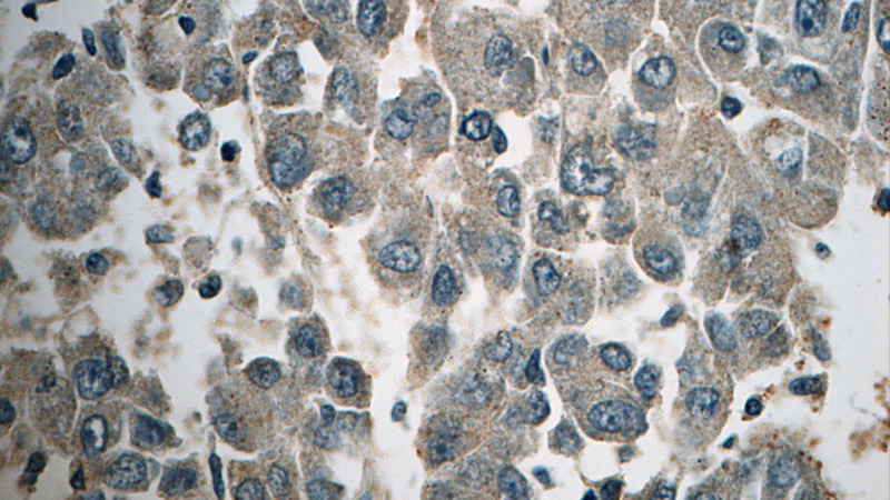 Immunohistochemistry of paraffin-embedded human liver cancer tissue slide using Catalog No:108765(CACNG1 Antibody) at dilution of 1:50 (under 40x lens)