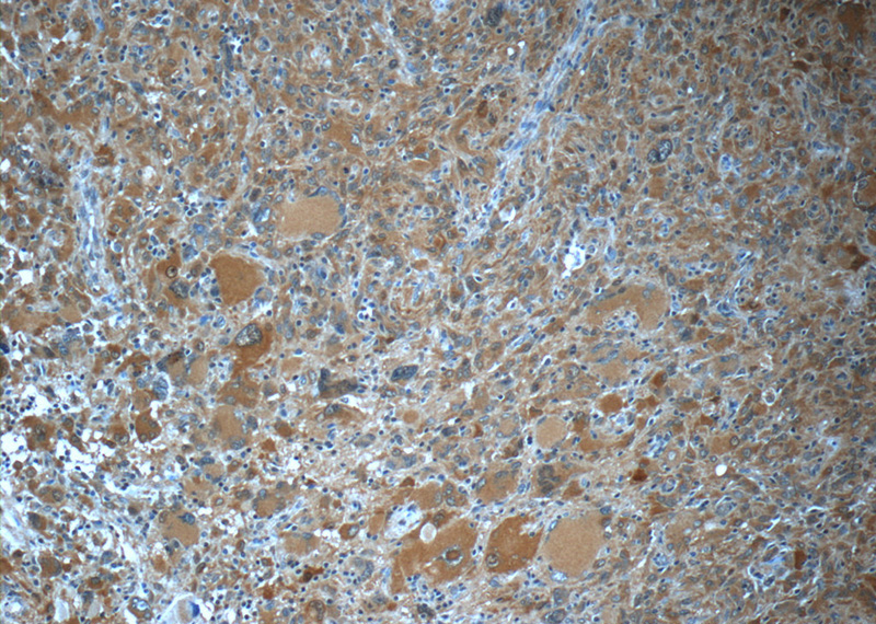 Immunohistochemistry of paraffin-embedded human gliomas tissue slide using Catalog No:116142(TIMP4 Antibody) at dilution of 1:50 (under 10x lens)