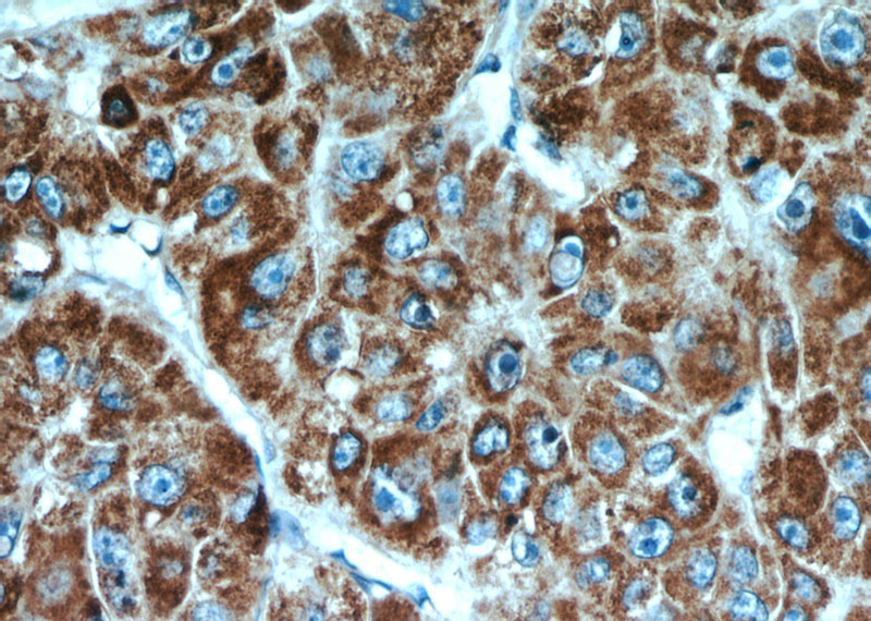 Immunohistochemical of paraffin-embedded human liver cancer using Catalog No:109530(CPT1A antibody) at dilution of 1:100 (under 40x lens)