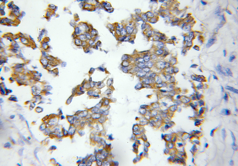 Immunohistochemical of paraffin-embedded human breast cancer using Catalog No:108209(ASAH1 antibody) at dilution of 1:50 (under 40x lens)
