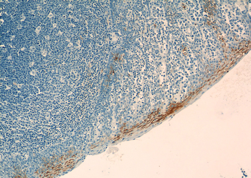 Immunohistochemistry of paraffin-embedded human tonsillitis tissue slide using Catalog No:112398(LY6D Antibody) at dilution of 1:50 (under 10x lens)