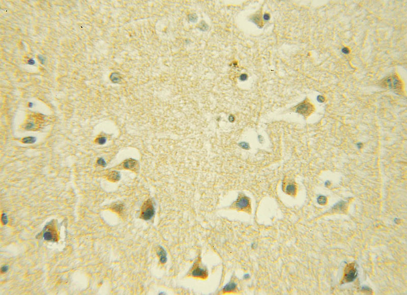 Immunohistochemical of paraffin-embedded human gliomas using Catalog No:110834(GALC antibody) at dilution of 1:50 (under 10x lens)