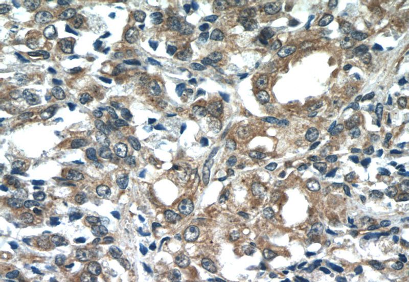Immunohistochemistry of paraffin-embedded human prostate cancer tissue slide using Catalog No:109489(FAM36A Antibody) at dilution of 1:50 (under 40x lens)