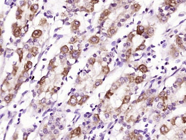 Fig2: Paraformaldehyde-fixed, paraffin embedded (human stomach tissue); Antigen retrieval by boiling in sodium citrate buffer (pH6.0) for 15min; Block endogenous peroxidase by 3% hydrogen peroxide for 20 minutes; Blocking buffer (normal goat serum) at 37℃ for 30min; Antibody incubation with (Glucagon Receptor) Polyclonal Antibody, Unconjugated at 1:400 overnight at 4℃, followed by operating according to SP Kit(Rabbit) (sp-0023) instructionsand DAB staining.