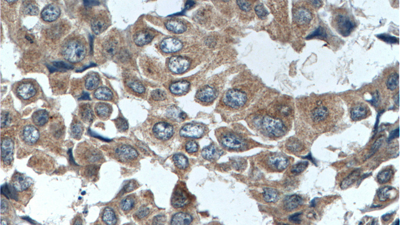 Immunohistochemistry of paraffin-embedded human breast cancer tissue slide using Catalog No:115749(SURVIVIN Antibody) at dilution of 1:200 (under 40x lens). heat mediated antigen retrieved with Tris-EDTA buffer(pH9).