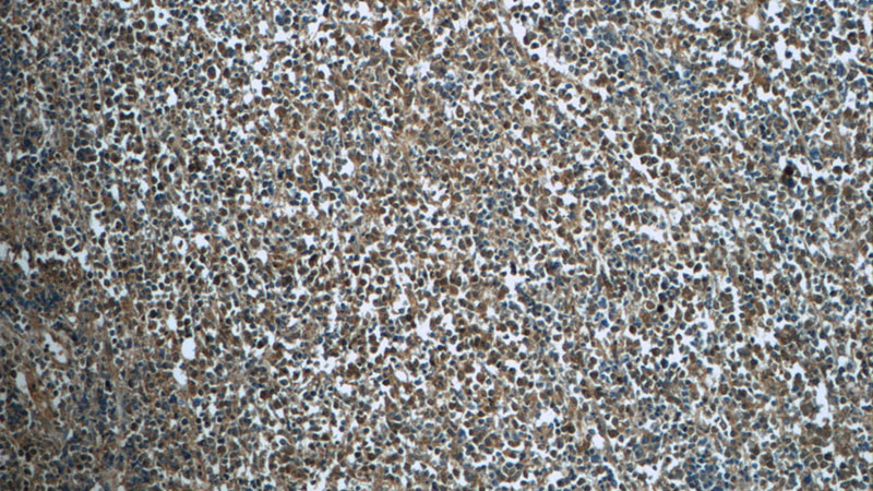 Immunohistochemistry of paraffin-embedded human lymphoma tissue slide using Catalog No:107147(CDK2 Antibody) at dilution of 1:50 (under 10x lens)