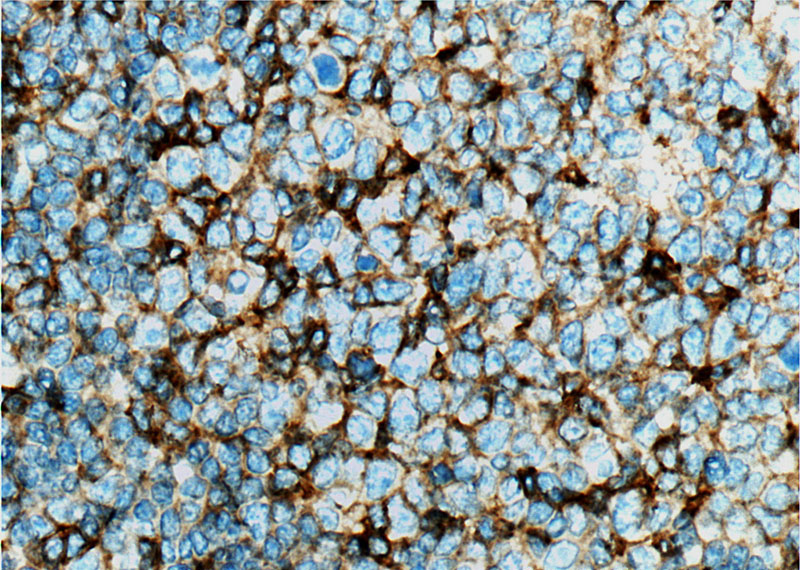 Immunohistochemistry of paraffin-embedded human tonsillitis tissue slide using (CD11a/Integrin alpha-L Antibody) at dilution of 1:500 (under 40x lens). heat mediated antigen retrieved with Tris-EDTA buffer(pH9).