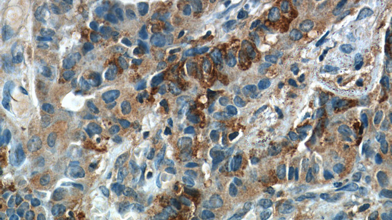 Immunohistochemistry of paraffin-embedded human thyroid cancer slide using Catalog No:110470(FAM129A Antibody) at dilution of 1:50