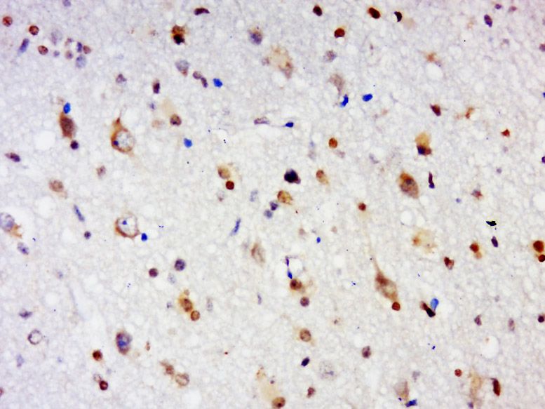 Fig2: Tissue/cell: human brain glioma; 4% Paraformaldehyde-fixed and paraffin-embedded;; Antigen retrieval: citrate buffer ( 0.01M, pH 6.0 ), Boiling bathing for 15min; Block endogenous peroxidase by 3% Hydrogen peroxide for 30min; Blocking buffer (normal goat serum,C-0005) at 37℃ for 20 min;; Incubation: Anti-EX33 Polyclonal Antibody, Unconjugated 1:500, overnight at 4℃, followed by conjugation to the secondary antibody(SP-0023) and DAB(C-0010) staining