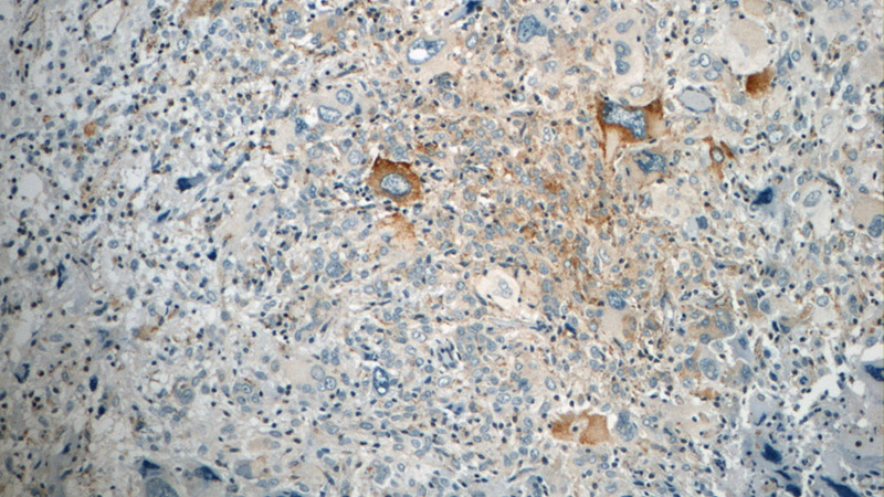 Immunohistochemistry of paraffin-embedded human gliomas tissue slide using Catalog No:114309(PTN Antibody) at dilution of 1:50 (under 10x lens)