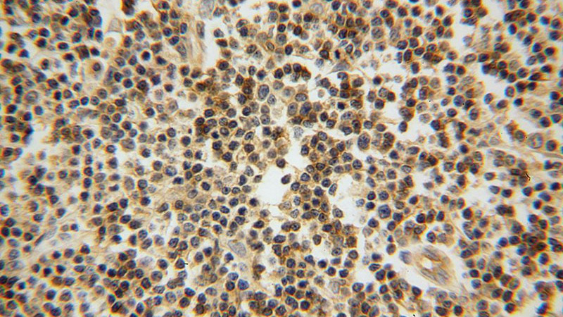 Immunohistochemical of paraffin-embedded human lymphoma using Catalog No:107275(IFITM1 antibody) at dilution of 1:50 (under 40x lens)