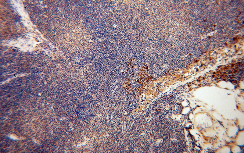 Immunohistochemical of paraffin-embedded human lymphoma using Catalog No:109674(PPIB antibody) at dilution of 1:100 (under 10x lens)