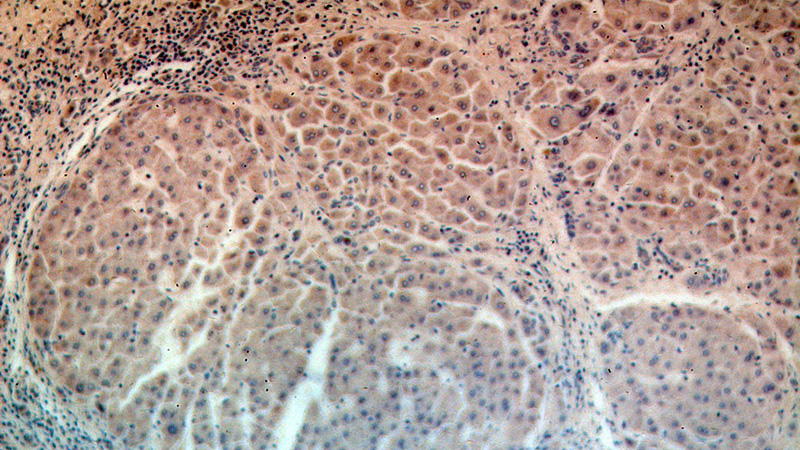 Immunohistochemical of paraffin-embedded human hepatocirrhosis using Catalog No:116644(URM1 antibody) at dilution of 1:100 (under 10x lens)