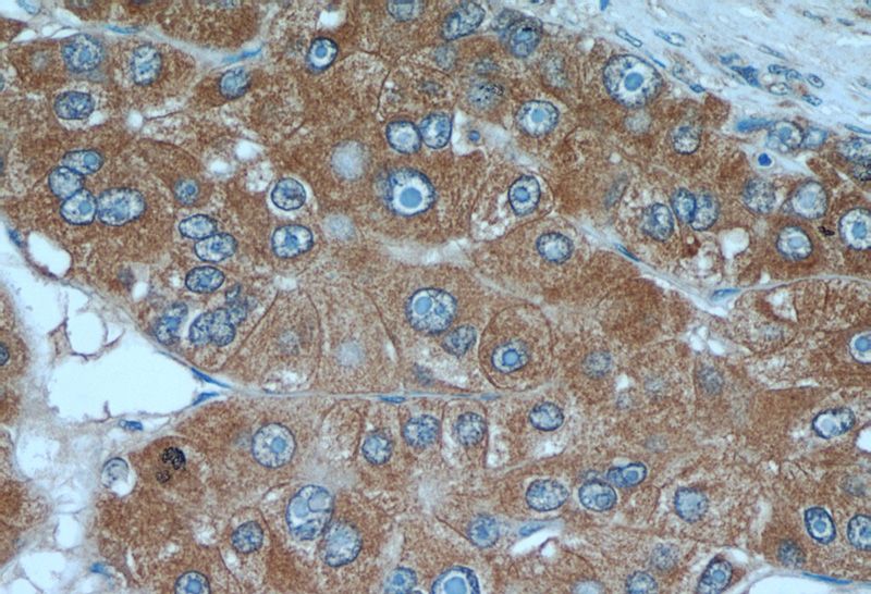 Immunohistochemical of paraffin-embedded human liver cancer using Catalog No:107912(AFP antibody) at dilution of 1:50 (under 40x lens)