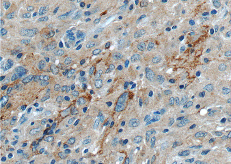 Immunohistochemistry of paraffin-embedded human gliomas tissue slide using Catalog No:109982(DKK1 Antibody) at dilution of 1:50 (under 40x lens)