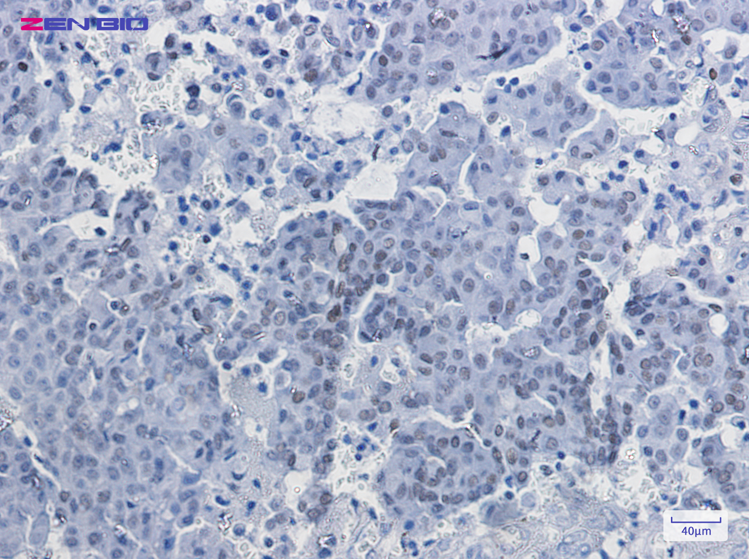 Immunohistochemistry of RUNX1/2/3 in paraffin-embedded Human breast cancer tissue using RUNX1/2/3 Rabbit pAb at dilution 1/50