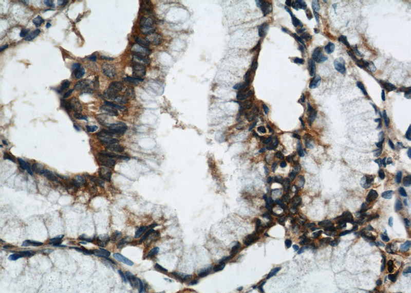 Immunohistochemical of paraffin-embedded human pancreas cancer using Catalog No:115123(SEPT9 antibody) at dilution of 1:50 (under 40x lens)