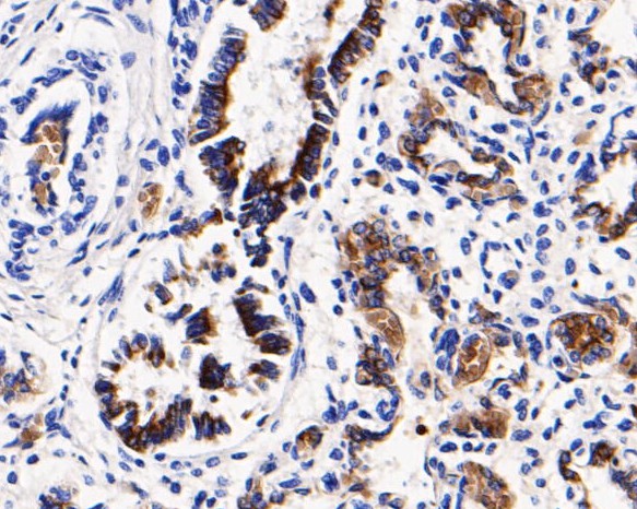 Fig4: Immunohistochemical analysis of paraffin-embedded human lung tissue using anti-CD68 antibody. The section was pre-treated using heat mediated antigen retrieval with Tris-EDTA buffer (pH 8.0-8.4) for 20 minutes.The tissues were blocked in 5% BSA for 30 minutes at room temperature, washed with ddH2O and PBS, and then probed with the primary antibody ( 1/200) for 30 minutes at room temperature. The detection was performed using an HRP conjugated compact polymer system. DAB was used as the chromogen. Tissues were counterstained with hematoxylin and mounted with DPX.