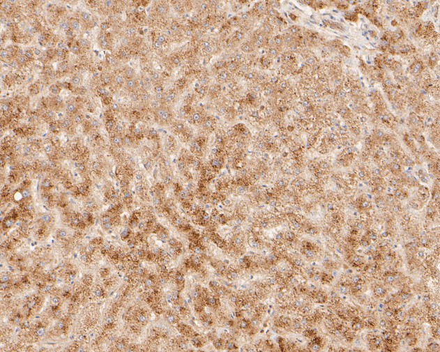 Fig3:; Immunohistochemical analysis of paraffin-embedded human liver tissue using anti-DNA2 antibody. The section was pre-treated using heat mediated antigen retrieval with sodium citrate buffer (pH 6.0) for 20 minutes. The tissues were blocked in 5% BSA for 30 minutes at room temperature, washed with ddH; 2; O and PBS, and then probed with the primary antibody ( 1/400) for 30 minutes at room temperature. The detection was performed using an HRP conjugated compact polymer system. DAB was used as the chromogen. Tissues were counterstained with hematoxylin and mounted with DPX.